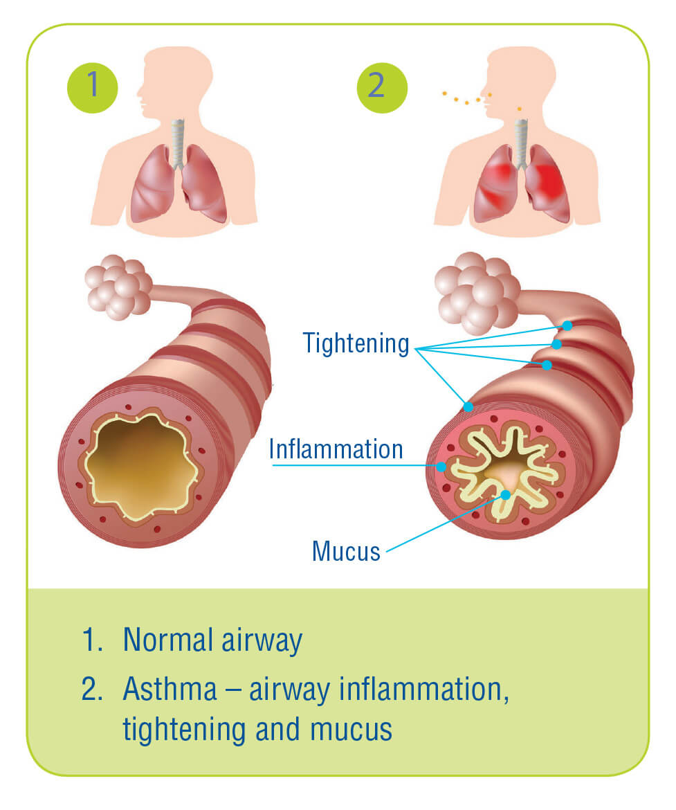 Asthma