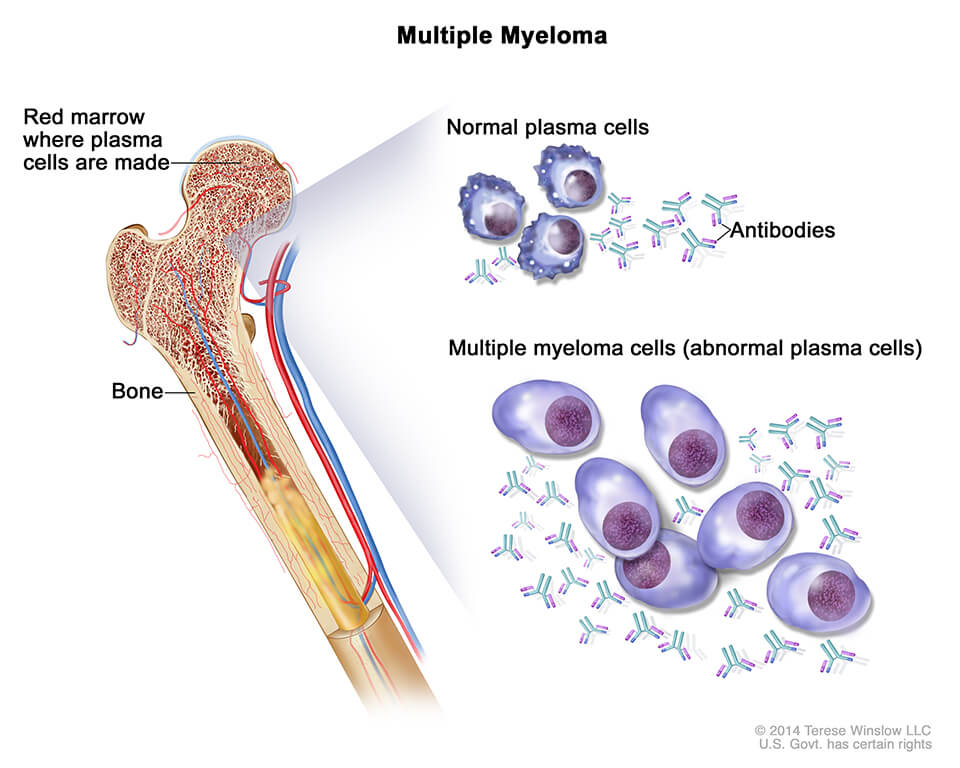 Multiple myeloma cells, plasma cells and antibodies